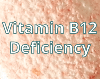 article preview  - Vitamin B12 Deficiency - Causes, Symptoms, Treatment
