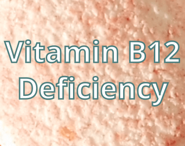 Vitamin B12 Deficiency - Causes, Symptoms, Treatment